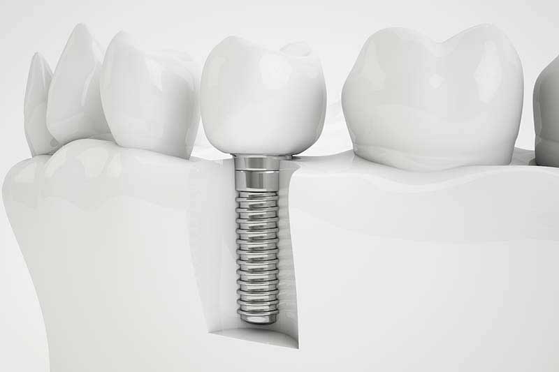 Cuba ultrassônica odontologica 3 CUBA ULTRASSÔNICA ODONTOLOGICA